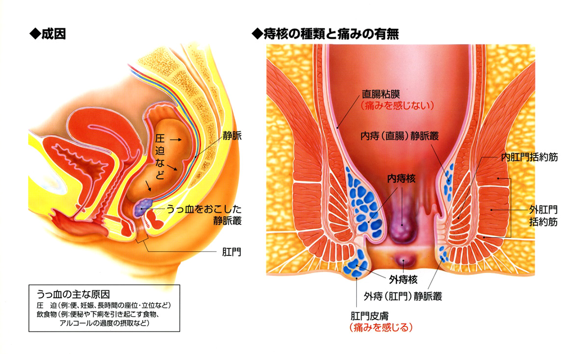 いぼ 痔 原因